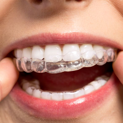 Close-up of a mouth wearing clear aligners