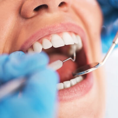 Close-up hygiene inspection during a dental appointment