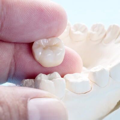 Model of a dental crown